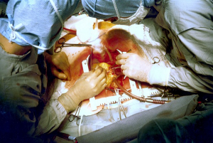 Coronary bypass surgery